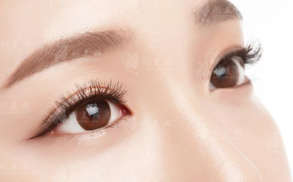 內(nèi)眥贅皮一定要開眼角嗎? 內(nèi)眥贅皮一定要開眼角嗎?