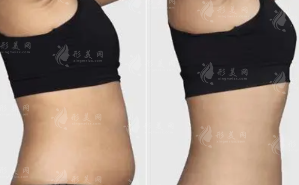 吸脂減肥塑身衣：何時(shí)穿戴，術(shù)后注意事項(xiàng)