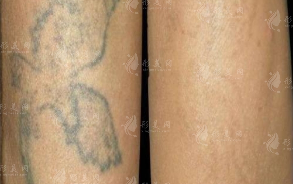激光洗紋身會留疤嗎？真實(shí)的效果如何？