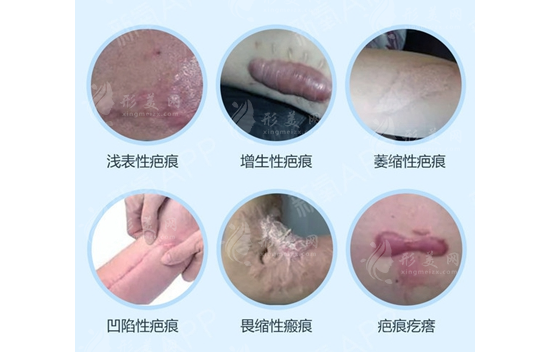 上海健橋醫(yī)院治療疤痕怎么樣？疤痕/胎記/血管瘤治療都不錯