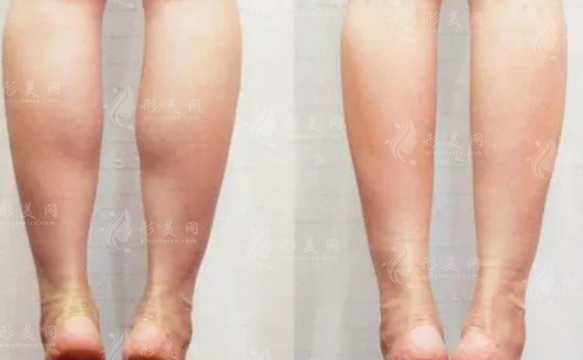 怎么快速瘦小腿？吸脂后怎么護(hù)理腿部？