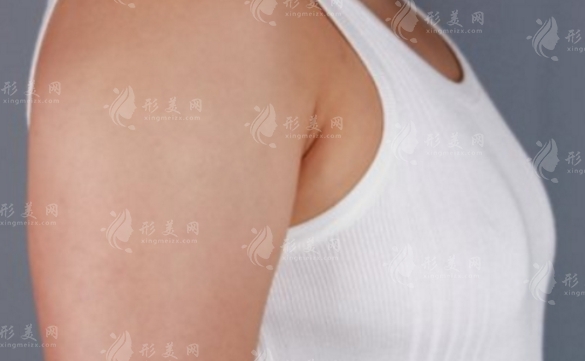 硅膠隆胸取出后可以用脂肪填充嗎？術后注意事項詳解