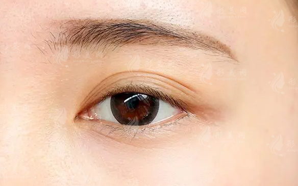 如何去除眼角細(xì)紋:手術(shù)與非手術(shù)方法的比較 如何去除眼角細(xì)紋:手術(shù)與非手術(shù)方法的比較
