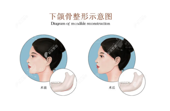 成都磨骨手術(shù)專家盤點:擁有四級手術(shù)資質(zhì)的精英醫(yī)生 成都磨骨手術(shù)專家盤點:擁有四級手術(shù)資質(zhì)的精英醫(yī)生