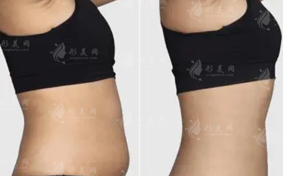 水動(dòng)力吸脂手術(shù)效果與過(guò)程解析