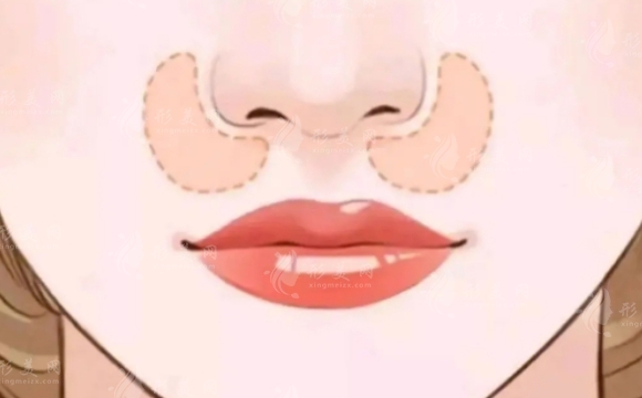 墊鼻基底與法令紋的改良:術(shù)后護(hù)理的重要性 墊鼻基底與法令紋的改良:術(shù)后護(hù)理的重要性