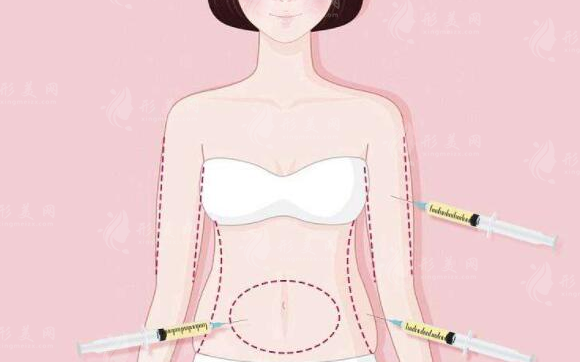 抽脂腹部有幾個(gè)部位？身體哪些部位容易堆積脂肪呢？