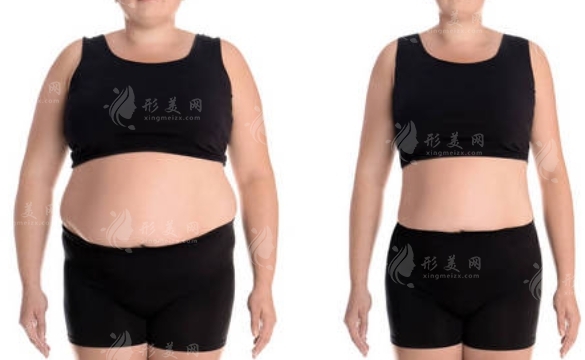 專業(yè)吸脂減肥塑身：注意事項與術(shù)后護理