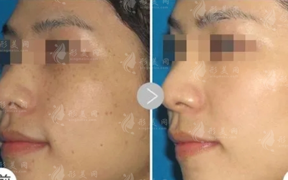 光子嫩膚可以去除斑點嗎？需要做多少次？術(shù)后效果怎么樣？