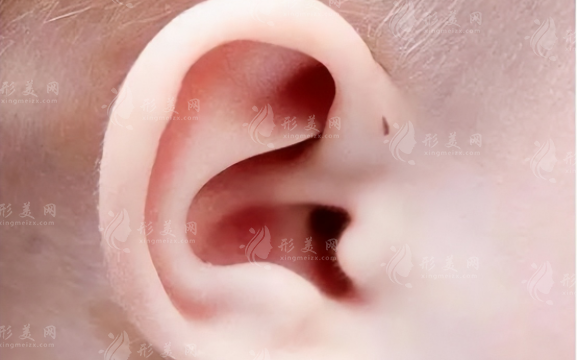 耳朵矯正手術(shù)會(huì)有缺陷嗎？矯正后容易反彈嗎?