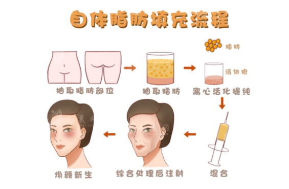 揭秘八大處李發(fā)成脂肪填充:精湛技藝與價(jià)格透明度解析 揭秘八大處李發(fā)成脂肪填充:精湛技藝與價(jià)格透明度解析