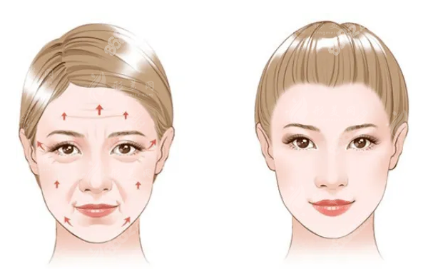 北京加減美面部提升：V9與V6怎么選？從切口大小與價(jià)格優(yōu)勢(shì)談起