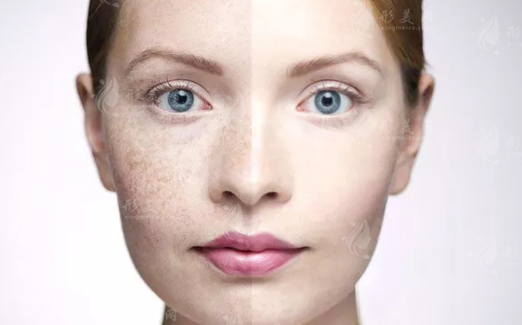 為什么激光可以祛斑，激光祛斑會留疤嗎？