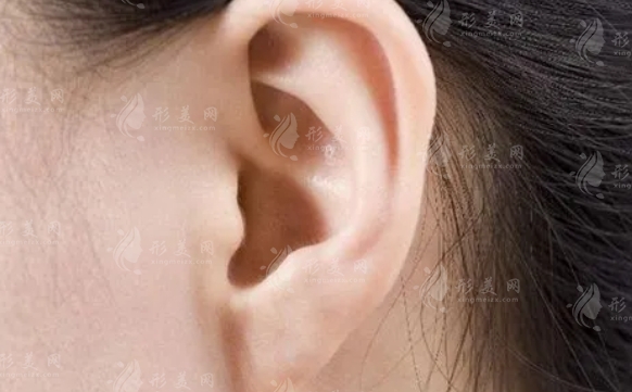 玻尿酸豐耳垂:危險(xiǎn)與栓塞的風(fēng)險(xiǎn)分析 玻尿酸豐耳垂:危險(xiǎn)與栓塞的風(fēng)險(xiǎn)分析