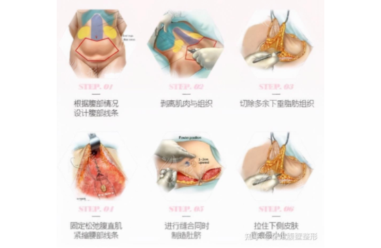腹壁成形手術(shù)