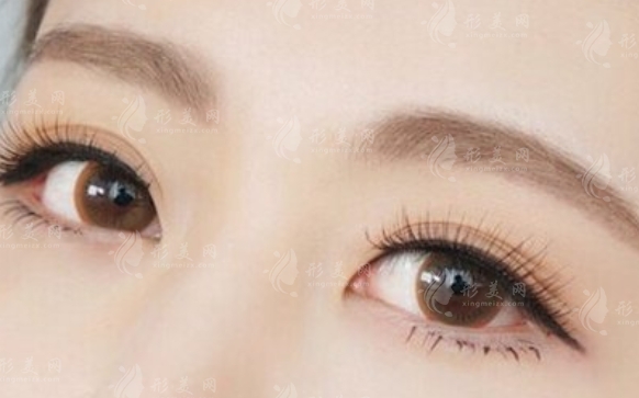 常見的切眉手術(shù)方法及其適用人群