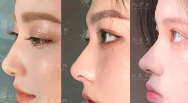 范榮杰醫(yī)生做鼻子技術(shù)怎么樣？