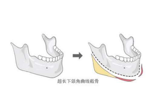 廣東韓妃整形外科醫(yī)院做頜面輪廓手術(shù)怎么樣？
