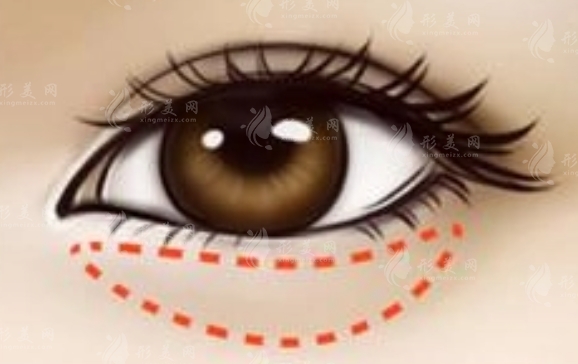 內(nèi)切眼袋手術(shù)后的注意事項(xiàng)