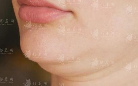 雙下巴吸脂術(shù)后恢復(fù)時(shí)間探討
