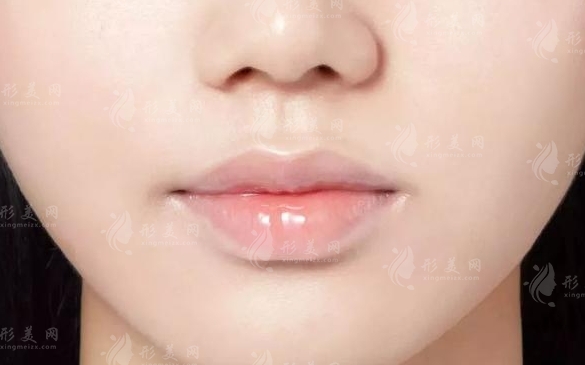 唇部提升手術(shù):解析與適用人群探討
