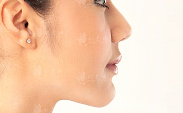 隆鼻后恢復(fù)時(shí)間長(zhǎng)嗎？如何預(yù)防隆鼻引起的鼻梁發(fā)紅？