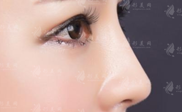 耳軟骨墊鼻尖后恢復(fù)期注意事項
