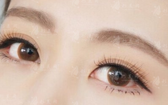 切眉手術：美麗升級，重塑眉形