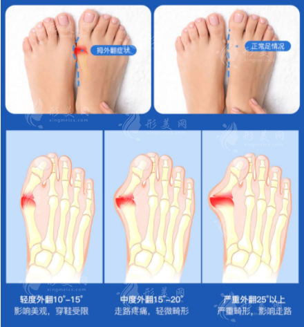 大腳骨矯正