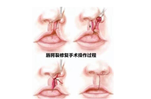 唇腭裂修復(fù)