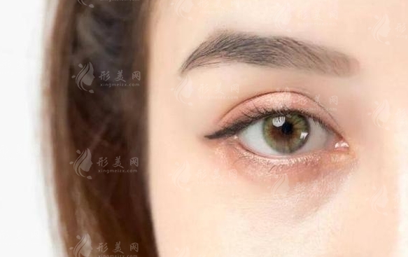 自體脂肪填充眼窩的安全性及手術次數解析 自體脂肪填充眼窩的安全性及手術次數解析