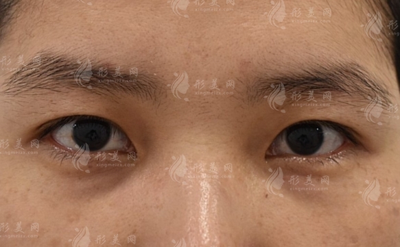 影響自體脂肪填充淚溝維持時間的因素分析 影響自體脂肪填充淚溝維持時間的因素分析