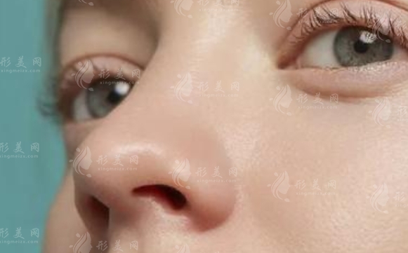 耳軟骨墊鼻尖后鼻子為何變硬