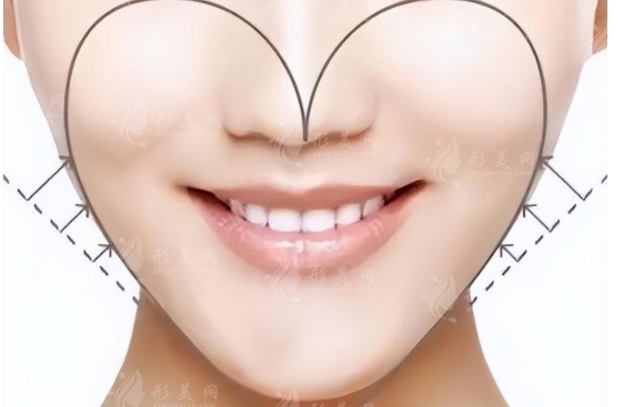 探索填充蘋(píng)果肌價(jià)格的影響因素 探索填充蘋(píng)果肌價(jià)格的影響因素