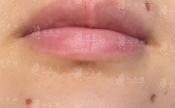 激光去痣后出現(xiàn)凹坑：應(yīng)對(duì)策略與解決方案