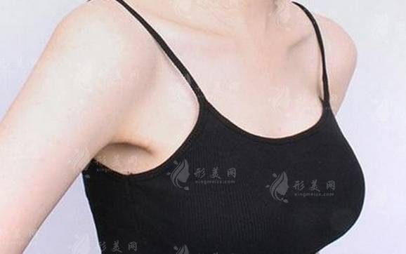 何時(shí)需考慮去除豐胸材料：安全、健康與個(gè)體需求的綜合考量