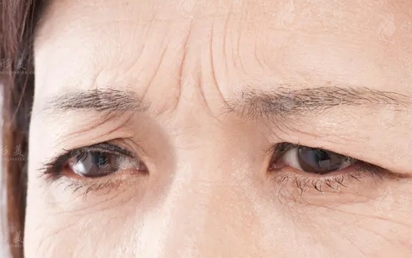 眉間皺紋的常見類型及去除方法 眉間皺紋的常見類型及去除方法