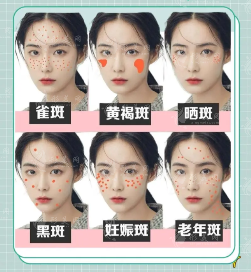 你的色斑是哪種？