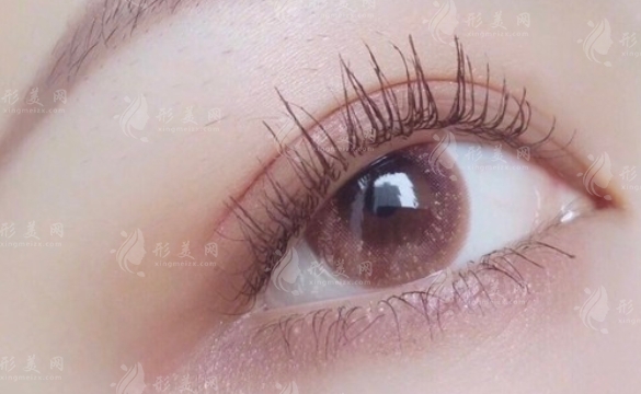 疤痕體質(zhì)可以割雙眼皮嗎？全切雙眼皮手術(shù)費用貴嗎？