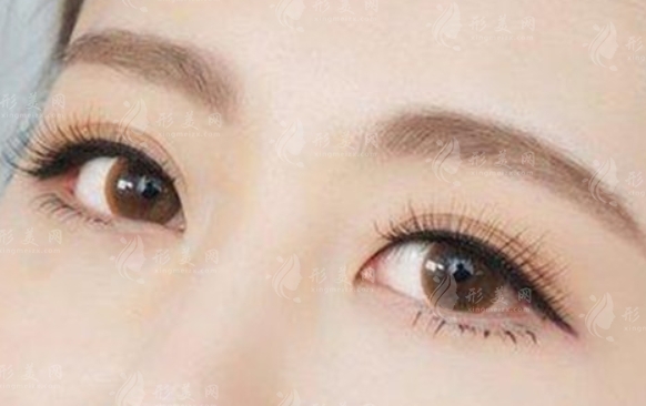 哪些人不適合割雙眼皮及手術(shù)后注意事項分享