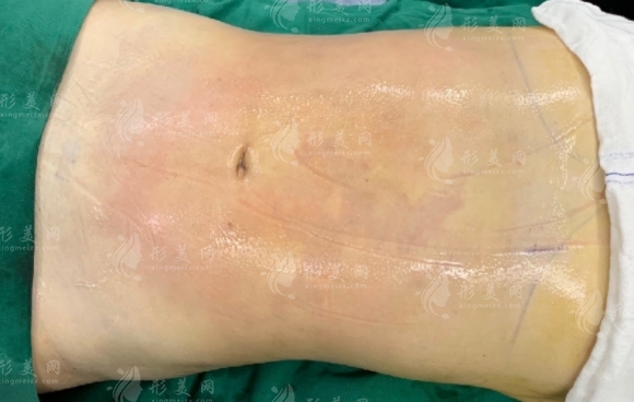 腰腹吸脂后多久開始瘦？要恢復(fù)多久？