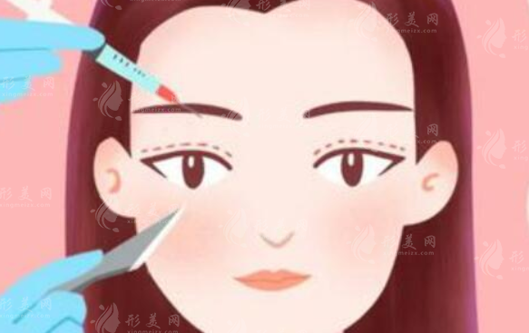 杭州美萊整形雙眼皮多少錢？醫(yī)生信息盤點，雙眼皮案例、價格表