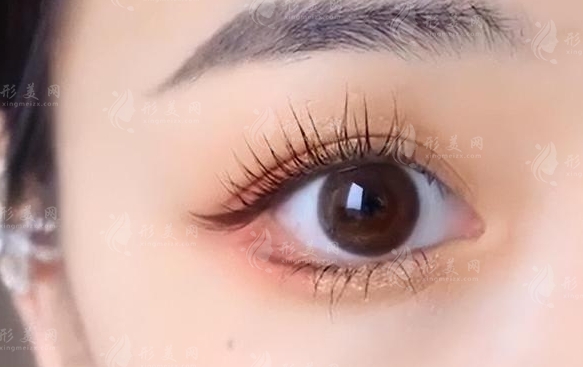 埋線雙眼皮維持多久？怎樣能加長維持時間？
