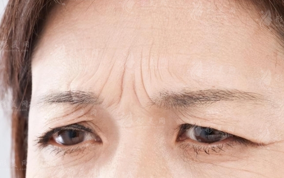 額頭除皺術(shù)的方法與注意事項(xiàng)