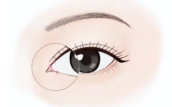 輕度內(nèi)眥贅皮的矯正與調(diào)節(jié)原則 輕度內(nèi)眥贅皮的矯正與調(diào)節(jié)原則