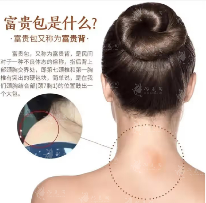 成都哪個醫(yī)院能做富貴包手術(shù)？什么是富貴包？哪些醫(yī)院比較好？
