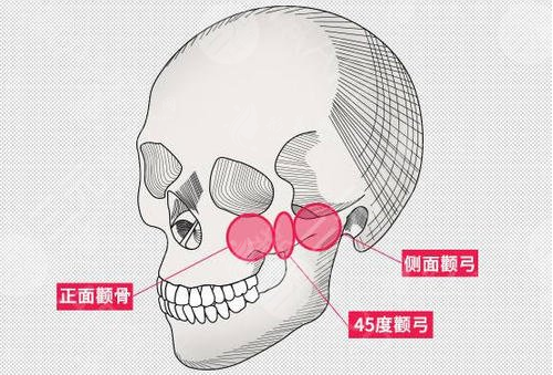武漢磨顴骨醫(yī)院哪家好？中翰、亞韓、華美整形磨骨手術(shù)口碑好