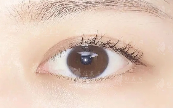 做雙眼皮手術(shù)需要多少錢？割雙眼皮后有哪些后遺癥？