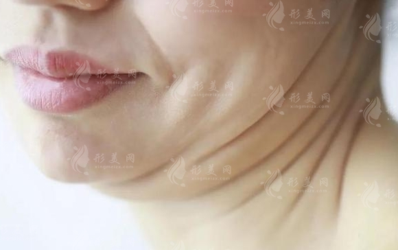 雙下巴抽脂減肥：價格與效果全面解析