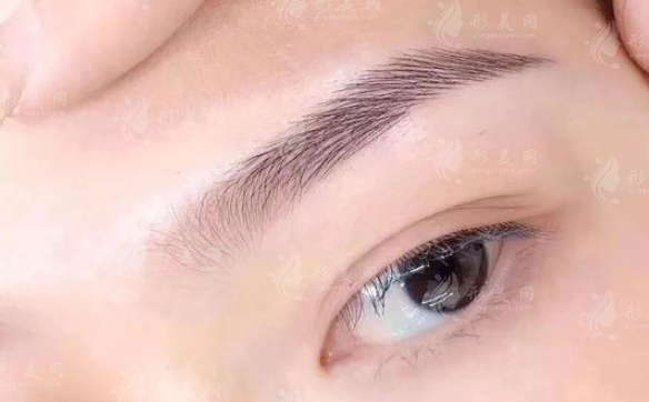 提眉手術(shù):效果持久與消腫時間解析 提眉手術(shù):效果持久與消腫時間解析